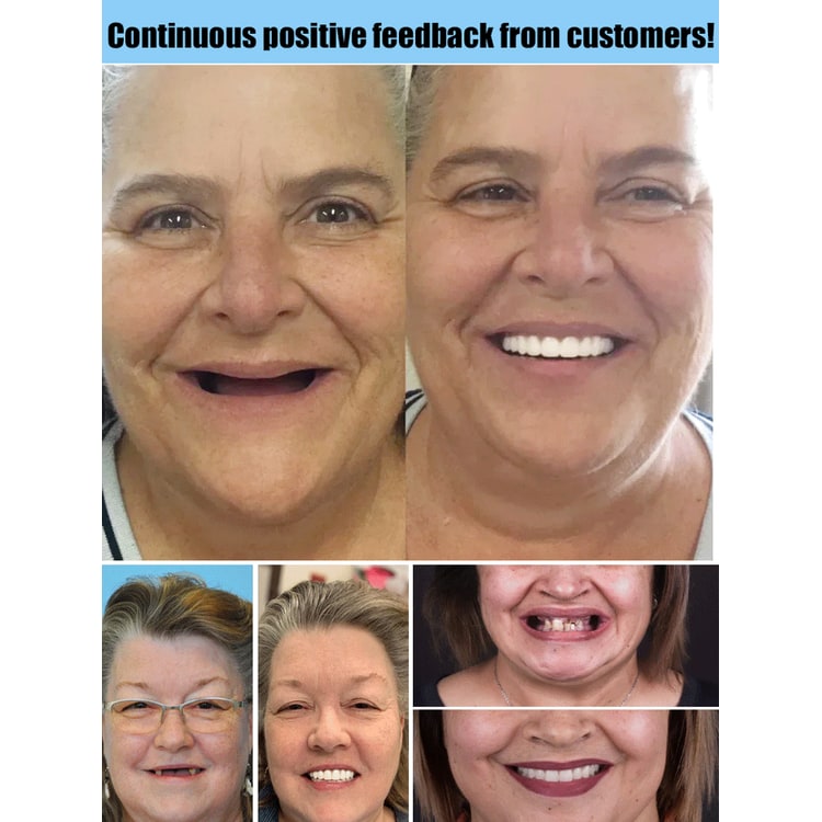 Snap on Veneers Upper and Lower Moldable Cosmetic False Teeth with Adjustable Fit - Image 5